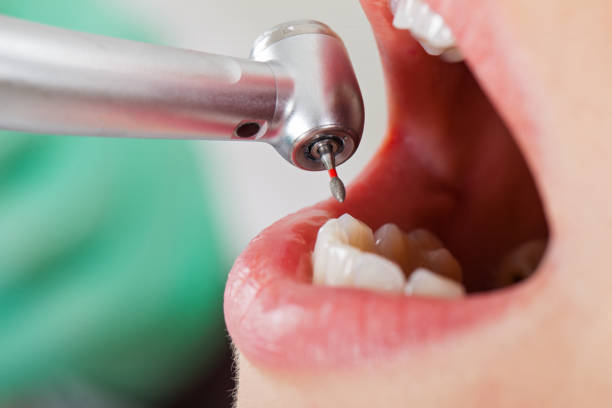 Best Emergency Dentist for Lost Fillings or Crowns in New Johnsonville, TN